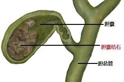 胆结石开刀多久旅游-做完胆结石手术多久可以开车