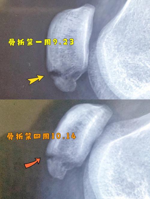 髌骨断裂多久能旅游-髌骨断裂多久能走路